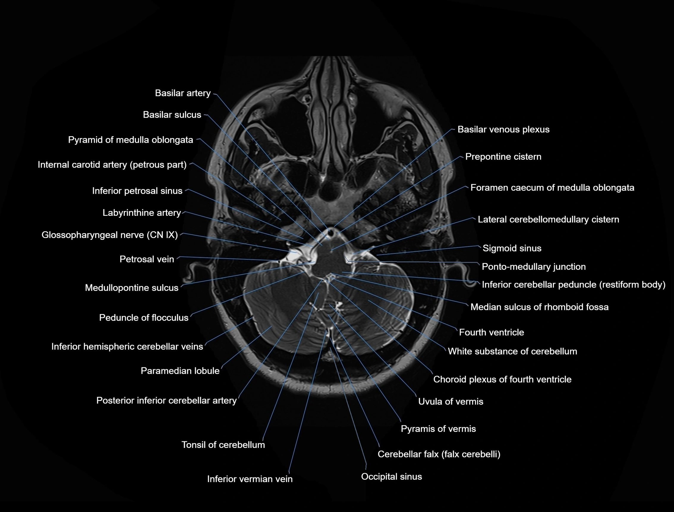 MRI Brain axial cross sectional radiology anatomy 3T image  -img-00001-00010.webp